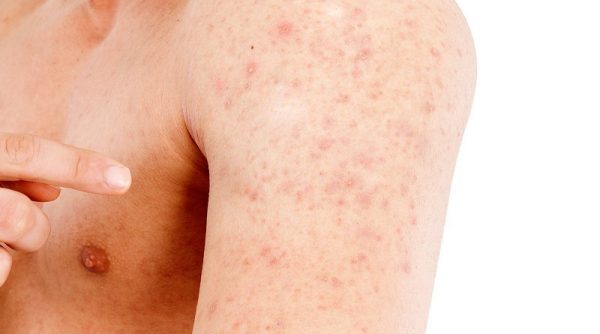 Can I Use Toothpaste on Pimples