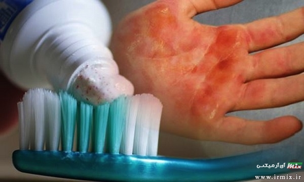 از بین بردن جای سوختگی تازه